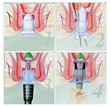 痔疮吻合器怎么使用吻合器痔上黏膜环形切除术。_https://www.jmylbn.com_新闻资讯_第1张