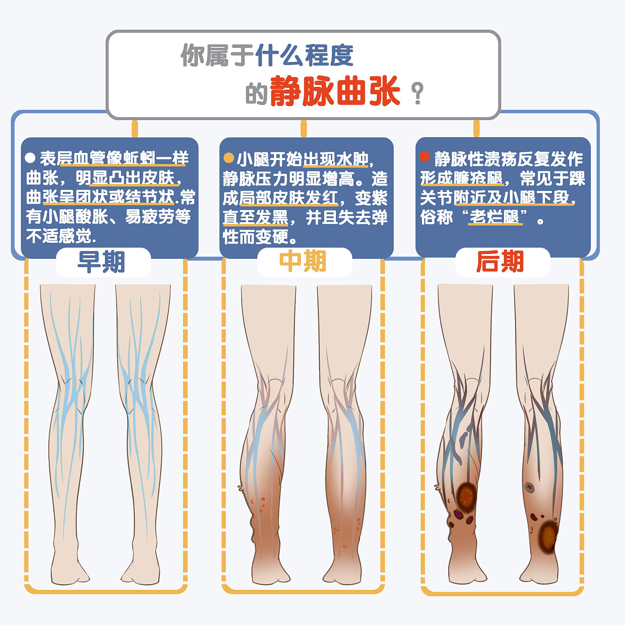 静脉曲张六个阶段图片