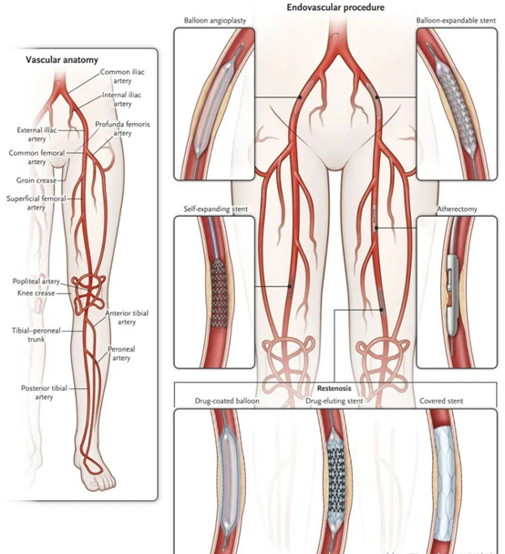 下肢动脉硬化闭塞症的诊疗