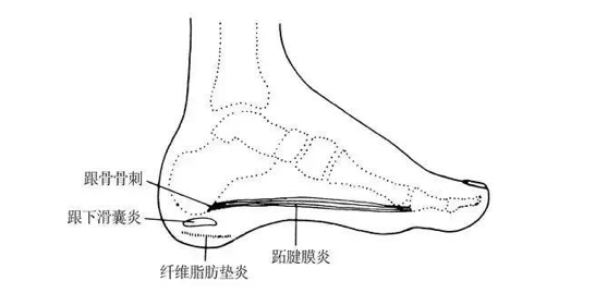 第三种:跖筋膜炎