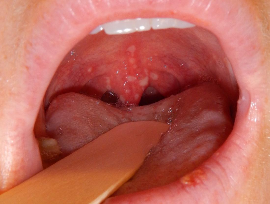 herpangina-br-image-credit-james-heilman-md-2016-january-8-br.jpg