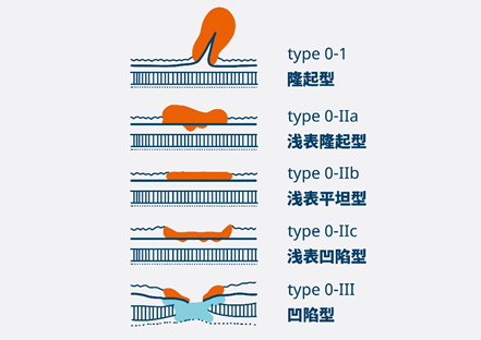 胃癌基础知识大盘点胃癌的分型与分期