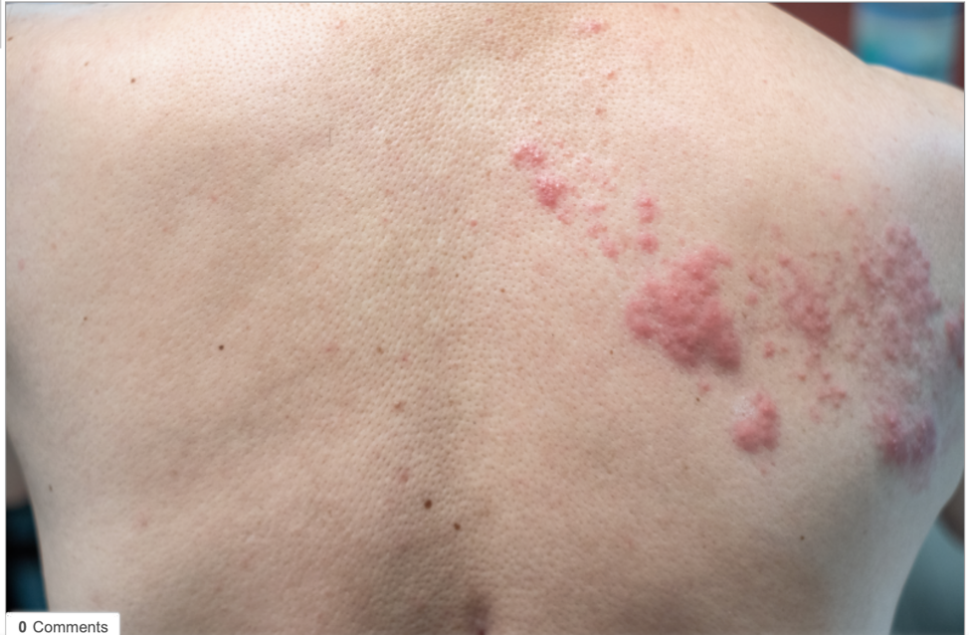 主题民间俗称缠腰龙的带状疱疹为什么可能会让人痛不欲生