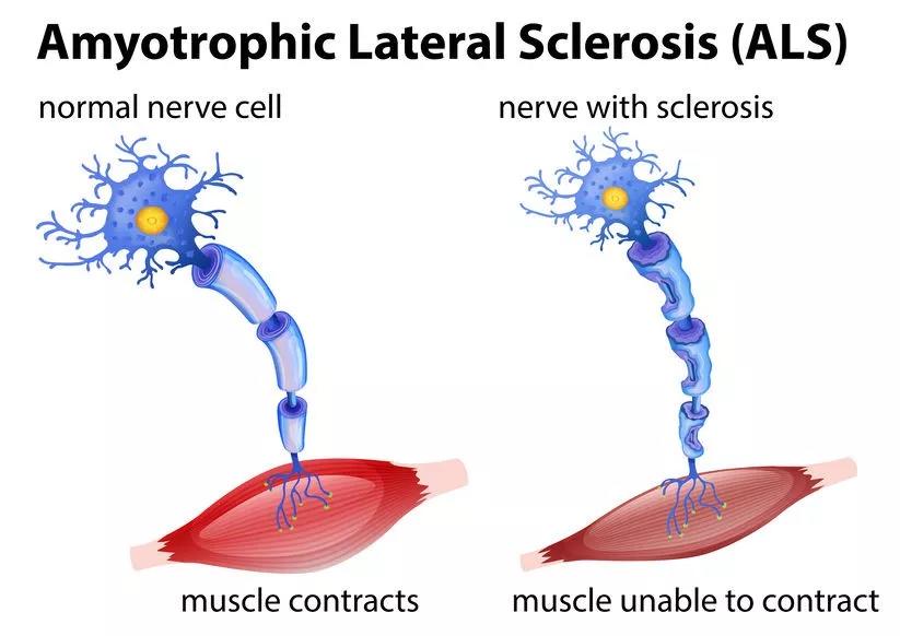 初期 症状 als ALSの症状チェック！3つの初期症状や原因を解説！