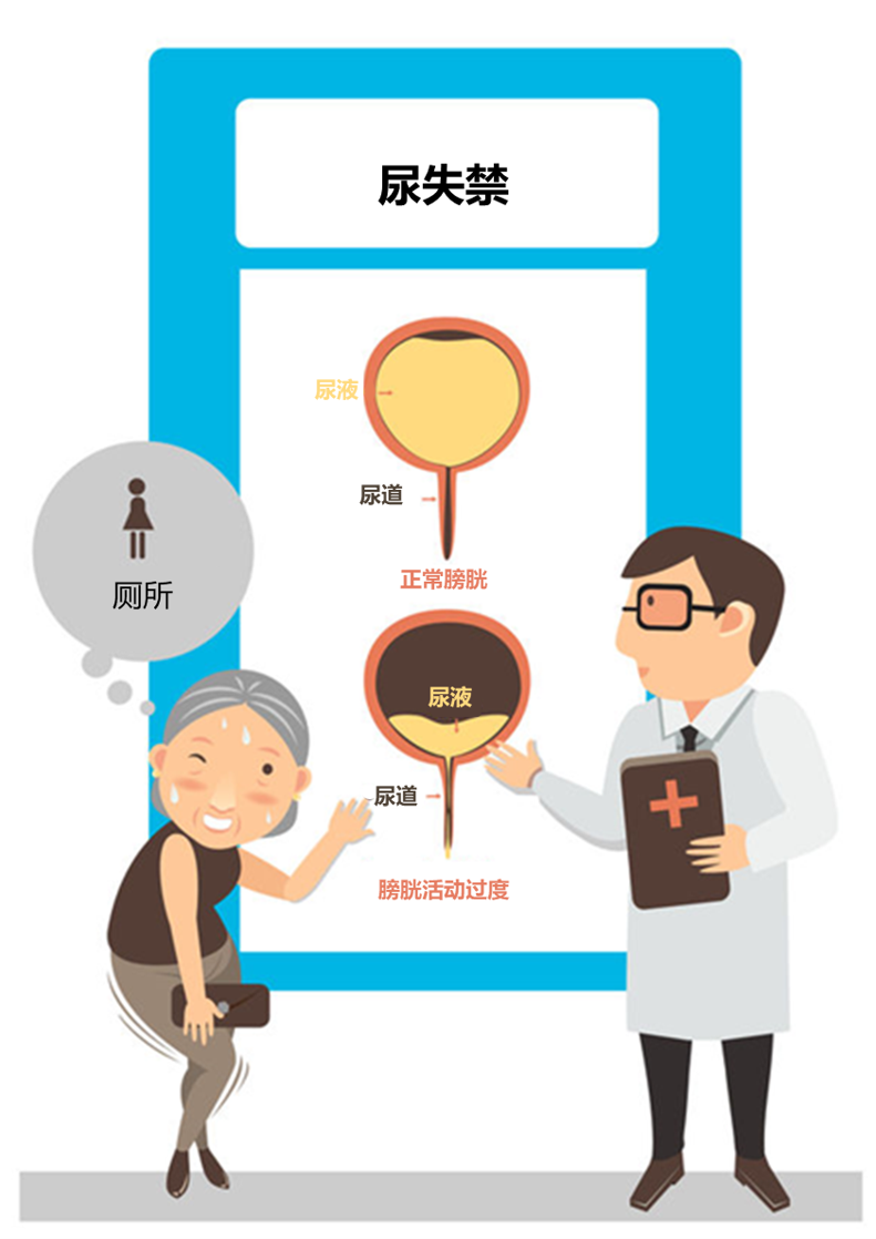 雌激素下降及不良分娩等原因,比男性更容易发生尿失禁 [3]