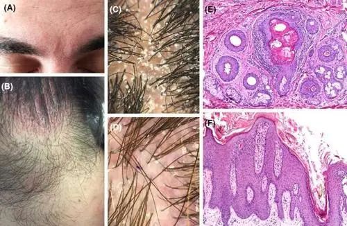 真菌性頭皮疾病的常見表現(圖片來源於網絡,侵刪)