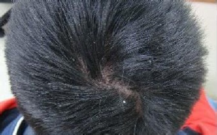 头屑反复、头皮瘙痒——高压学习下的头皮问题在敲警钟!-春雨医生