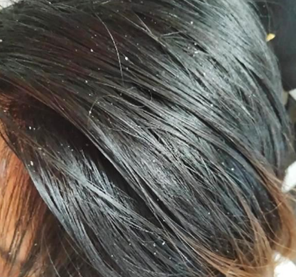 头发油腻,头屑反复,女性朋友更要留意脂溢性皮炎!