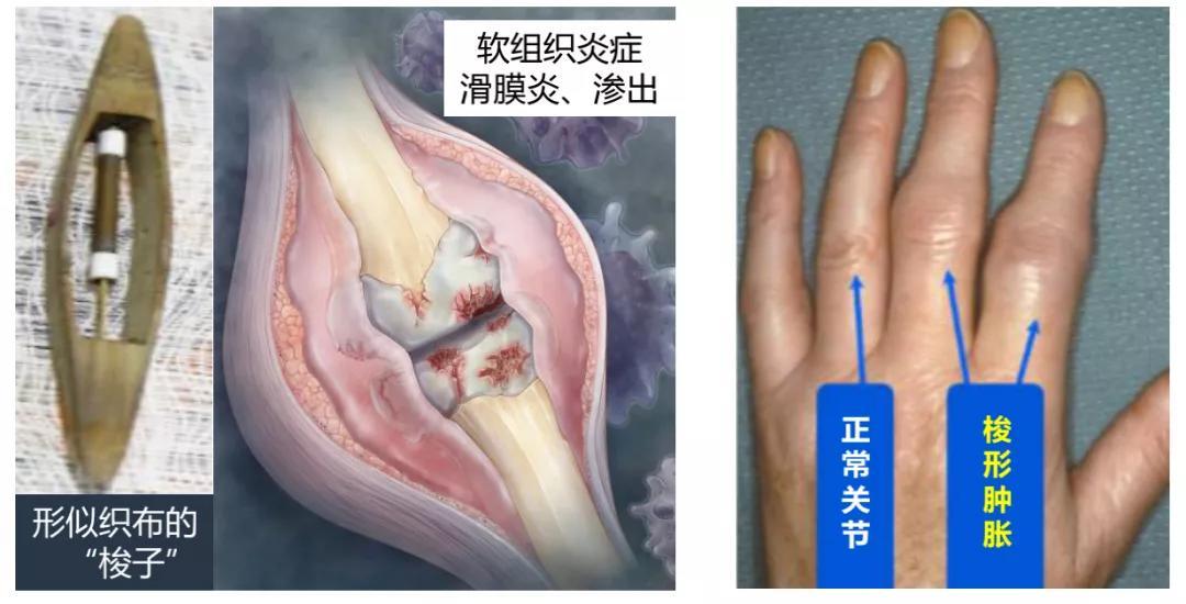 这是关节周围软组织炎症,滑膜炎症渗出或滑膜组织增生所致,局部 皮肤