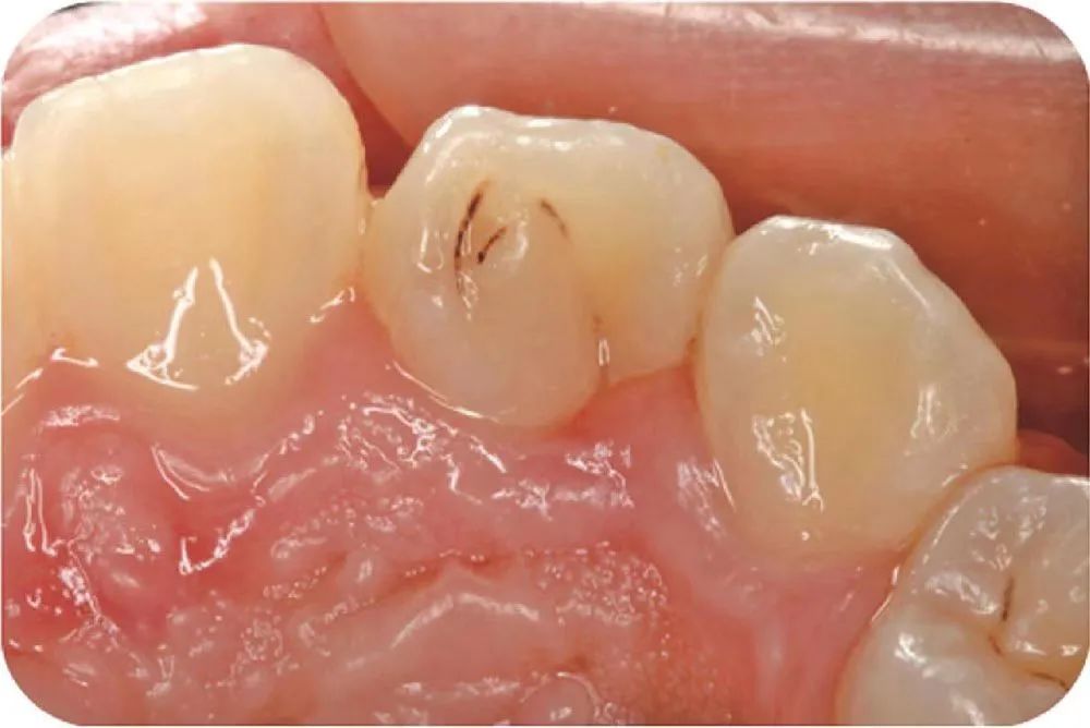 窝沟龋早期的表现就是后牙咬合面有黑线,这个时候的牙齿龋坏(龋齿中的
