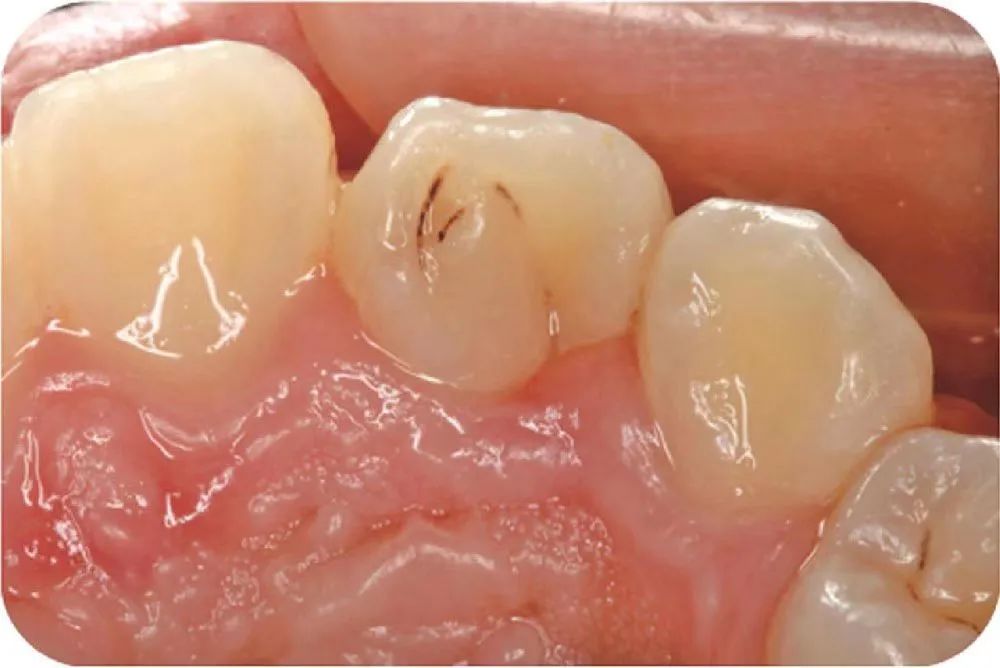 牙槽窝沟变黑了图片